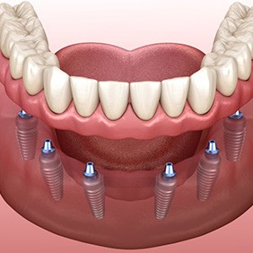 Illustration of implant denture for lower arch