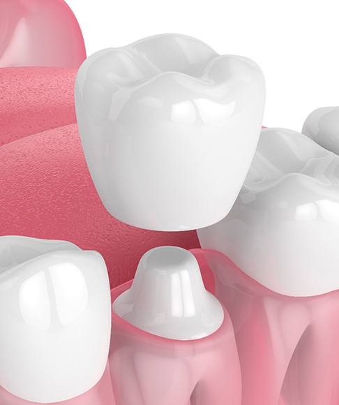 a digital illustration of a Same-Day Zirconia crown