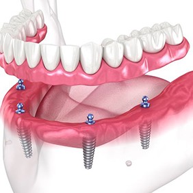 Illustration of implant dentures for lower dental arch