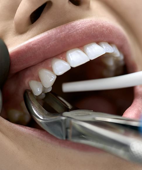 Patient in Vero Beach getting a tooth extracted