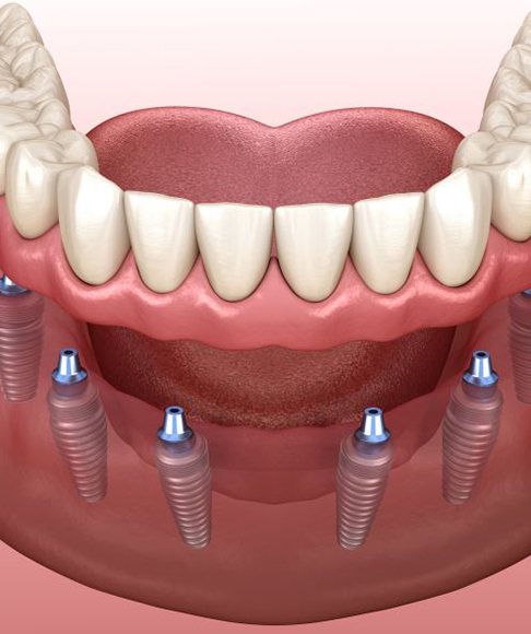 Digital image of implant denture for lower arch