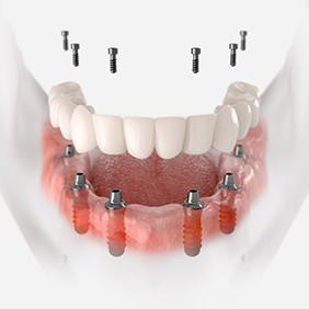 Illustration of fixed implant denture for lower arch