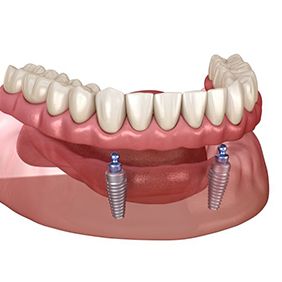 Illustration of ball-retained implant denture