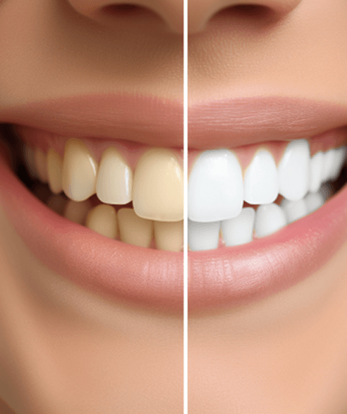 Close-up image of teeth before and after teeth whitening